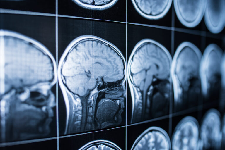 Más de medio millón de residentes en Colorado viven con secuelas de lesiones cerebrales